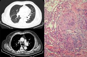 Left: chest HRCT slices showing septal thickening, with nodules predominantly in the subpleural and fissure regions. Mediastinum showing presence of hilar and mediastinal lymphadenopathies measuring up to 15mm. Right: transbronchial biopsy specimen showing non-caseifying epithelioid granulomas. Multinucleated giant cells grouping to form granulomas with scant accompanying lymphocytic cellularity. No necrosis identified.