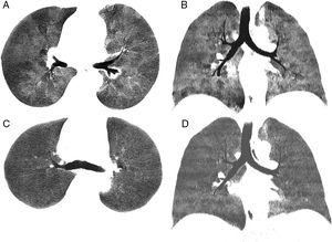 Chest minIP (Minimum Intensity Projection) CT axial (A) and coronal (B) images in expiration showing a marked mosaic attenuation pattern in the pulmonary parenchyma, with geographical regions of low density alternating with areas of greater attenuation. The areas of lower density correspond to air trapping. Chest minIP (Minimum Intensity Projection) CT axial (C) and coronal (D) images in expiration showing less heterogeneity and greater uniformity of the attenuation of the pulmonary parenchyma with compared to images (A) and (B).