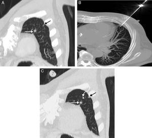 (A) MIP (maximum intensity projection) oblique coronal CT image of the chest in which 2 small opacities measuring <1cm are seen in the left upper lobe: a larger (white arrow) and another smaller lesion (black arrow). (B) MIP axial CT image of the chest showing the moment in which the seed was released from the 18G trocar needle. (C) MIP oblique coronal CT image of the chest confirming the correct equidistant placement of the I-125 seed (curved arrow) between the 2 lung lesions (straight arrows).