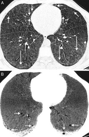 (A) Axial CT image of the chest (pulmonary parenchymal window) showing thickening of interlobular septa (short arrows) and areas of ground glass attenuation (arrows). (B) Minimum intensity projection (MinIP) axial CT image of the chest (pulmonary parenchymal window) showing small lung cysts in the basal segments of both lower lobes (arrows).