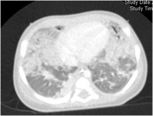 CT with bilateral granular opacities and ground-glass opacification.