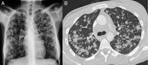 Posteroanterior chest X-ray (A) with patchy pseudonodular opacities, predominantly in the middle and upper fields. No pleural effusion or mediastinal widening is seen. Chest CT cross-sectional slice (B) showing centrolobular pulmonary opacities with a tendency to coalesce, predominantly in the upper and middle fields.