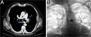 (A) CT scans with contrast medium, axial slice, showing a saccular aneurysm at the origin of the left bronchial artery (arrow). (B) Standard chest X-ray following embolization of the left bronchial artery aneurysm with coils.