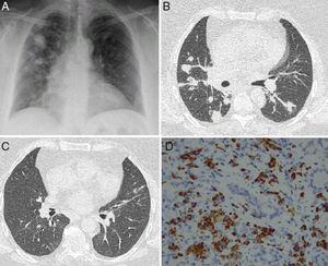 (A) Chest X-ray posteroanterior image with consolidations predominantly in the right side. (B) Axial CT showing masses and nodules associated with the consolidations. (C) Axial CT of the chest showing resolution of pulmonary lesions after corticoid therapy. (D) Lacrimal gland tissue showing interstitial inflammatory infiltrate caused by lymphocytes, macrophages, and plasma cells with cytoplasmic positivity for IgG4 (IgG4/IgG>40%).