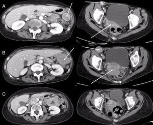 (A) Axial CT images of abdomen (left) and pelvis (right) showing right inguinal lymphadenopathy, a mass in the right adnexal region, and another in the left paracolic gutter (arrows). (B) Axial CT images of abdomen (left) and pelvis (right) obtained 8 weeks later, showing a striking increase in tumor lesions (arrows). (C) Axial CT images of abdomen (left) and pelvis (right) obtained 12 months later, demonstrating the disappearance of tumor lesions.