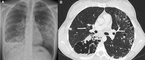 Chest X-ray: parenchymal consolidation with peribronchial distribution involving the RLL, the posterior segment of the right upper lobe, and the lingula. (A) Image of thin-walled cysts and air-fluid level in RLL. (B) Chest CT scan: solid and cystic nodular lesions of irregular appearance with bilateral peripheral distribution and area of consolidation with cystic image, with multiple septae and air-fluid level in right lower lung.