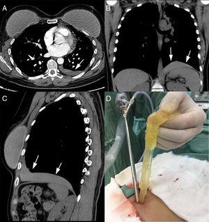 Axial (A), coronal (B), and sagittal (C) reformatted CT images show an elongated opacity at the base of the left hemithorax (arrows), just above the diaphragm, in the pleural cavity. (D) Left videotoracoscopy with removal of free silicone from the pleural cavity.