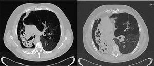 CT slices showing a collapsed right lung due to the presence of multiple bronchiectasis. Only the areas of emphysematous lung are aerated, with bullous changes. A small air-fluid level suggestive of superinfection over the bullous parenchyma can also be visualized. Moreover, major hyperinflation is present in the left lung with extensive areas of panacinar emphysema in the upper lobe. This hyperinflation, along with the collapse of the right lung, produces a significant shift in the mediastinum toward the contralateral side.
