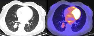 Positron emission tomography-computed tomography (PET-CT). Polylobulated lesion in the right lower lobe with mild uptake (SUVmax: 2.68).