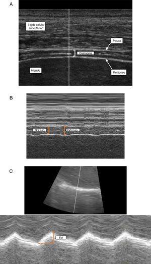 Diaphragmatic ultrasonography. Determination of diaphragm thickness in the zone of apposition with the chest wall in B-mode (A) and M-mode (B) and evaluation of diaphragmatic excursion (C). Edi: diaphragmatic excursion; Gdi esp: expiratory diaphragm thickness; Gdi insp inspiratory diaphragm thickness; Tejido celular subcutáneo: subcutaneous cellular tissue; Higado: liver; Diafragma: diaphragm; Pleura: pleura; Peritoneo: peritoneum.