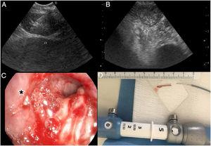 Accidental transbronchial needle breakage during endobronchial ultrasound.