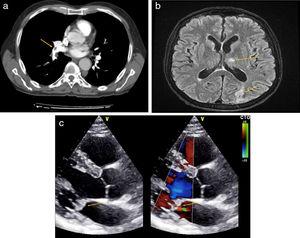 (a) CT angiography of pulmonary arteries. Filling defect in arteries of the right and left lower lobes consistent with PTE, arrow. (b) Brain MRI in T2. Ischemic impacts in cerebellar hemispheres and in the occipital region, arrows. (c) Echocardiogram in the long parasternal axis. Severe mitral insufficiency and endocardial masses on mitral valve, indicated with arrows.