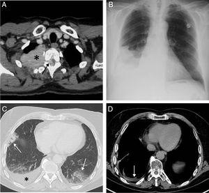 (A) Axial CT scan of the chest (mediastinum window) performed in 2012 that identifies a solid mass in the upper right hemithorax (asterisk) infiltrating the chest wall and penetrating the spinal canal through the right T2–T3 intervertebral foramen (arrow). (B) Posteroanterior chest X-ray performed in November 2017 showing right pleural effusion for the first time in this patient. (C) Chest axial image of a PET/CT scan performed in November 2017 which identifies bilateral opacities of pneumonic aspect (arrows) and right pleural effusion (asterisk). (D) Thoracic axial image of another PET/CT scan performed in March 2018 which shows the disappearance of pneumonic opacities and the presence of minimal pleural effusion.
