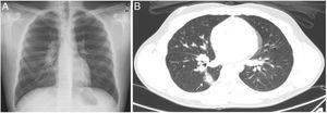 (A) Chest X-ray: bilateral hilar and paratracheal lymphadenopathies. (B) Chest CT: mediastinal and hilar lymphadenopathies, predominantly right-sided. Right parenchymal nodule measuring 15mm (arrow) with ground-glass halo and a tract connecting it with the hilum.
