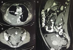 CT of Krukenberg tumor. (A) Axial CT slice from the chest showing right pleural effusion (PE) and right parahiliar solitary pulmonary nodule. (B) Pelvic axial CT slice showing pelvic mass. (C) Sagittal CT slice showing pelvic mass.
