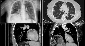 (A) Chest X-ray. (B) Lung CT: pulmonary nodules of fluid density. (C) Lung CT, sagittal slice: arrows indicate nodular images located in the interior of arterial branches. (D) Lung CT, coronal slice: hepatothoracic transitional cyst.