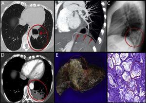 A: High-resolution CT, axial plane. Left lower lobe shows an area of destruction of the pulmonary parenchyma with less vascularity (red circle). The image of the larger cyst shows thickened walls and air-fluid level (arrow). B: Chest angio-CT scan with MIP and MPR reconstructions. An arterial branch is seen emerging from the celiac trunk (arrows) that supplies blood to the cystic mass and to the area of destruction. C: Chest X-ray, lateral projection. Consolidation seen in the left lower lobe (red circle), which in the clinical context of the patient was suggestive of pneumonia. D: Chest CT with intravenous contrast and imaging in arterial phase. The larger cystic lesion remains stable (arrow). Hypodense consolidation containing vessels seen within the CPAM (red circle). E: Macroscopic view of the surgical specimen. A whitish, indurated, condensation (red circle) is seen, extending through the pulmonary parenchyma in the form of nodules of variable size. F: Microscopic view of the lesion. Extensive architectural malformation with cystic areas (black arrows) associated with CPAM. Neoplastic proliferation of atypical mucinous epithelial cells covering the alveolar septa, with areas of pseudopneumonic pattern (red circles).