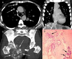 Chest computed tomography with axial (A) and coronal (B) reconstruction showing multiple pulmonary nodules, some with calcification (arrows). Note also in B a calcified mass in the right lobe of the liver (arrowheads). In C, computed tomography of the pelvis with coronal acquisition MIP reconstruction, showing an osteolytic lesion with internal foci of calcification (arrows) and invasion of surrounding soft tissue. In D, histological section of the pulmonary nodule demonstrating atypical neoplastic glands infiltrating the connective tissue amid desmoplastic stroma. Note also the amorphous basophilic material, compatible with extracellular deposition of calcium adjacent to the neoplastic process (arrows; hematoxylin and eosin stain, ×100).