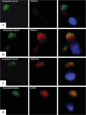 Immunofluorescence analysis of the ciliary ultrastructure. The first column shows the presence of cilia in the cell using acetylated tubulin (in green), the second shows the outcome of incubation with primary ciliary protein antibodies (in red), and the third shows the merge of tubulin with each ciliary protein and the DAPI-stained nucleus (blue). (A) Absence of protein DNAH5 (external component of dynein arms) in the ciliary axoneme. (B–D) Presence and colocalization of tubulin and ciliary axoneme proteins (in yellow): (B) DNALI1 (external component of dynein arms); (C) RSPH4A (radial spoke head component), and (D) GAS8 (nexin-dynein regulatory complex component).