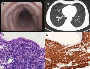 (A) Flexible bronchoscopy view of the trachea with multiple confluent nodules affecting the wall. (B) CT image showing tree-in-bud pattern, predominantly in the right upper lobe. (C and D) Histological sections of the bronchial mucosa showing a proliferation of cells of lymphoid appearance, hematoxylin/eosin staining (C), positive for CD20, immunohistochemical study (D).