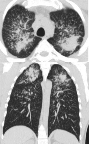 Chest HRCT with nodular interstitial pattern and PMF masses in a 34-year-old worker with 8 years of exposure to quartz conglomerates. PMF: progressive massive fibrosis.