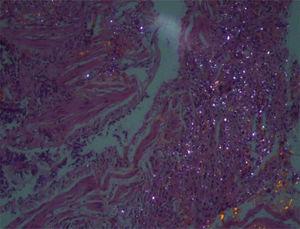 Polarized light microscopy showing birefringent particles associated with silica over areas of interstitial fibrosis.