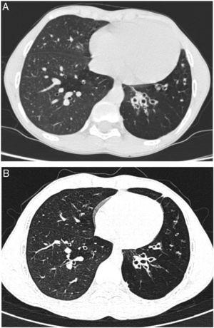 Computed tomography of the chest, before (A) and after 19 months of treatment (B), showing no progression of the emphysema or bronchiectasis.