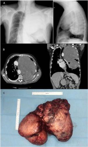 (A) Posteroanterior and lateral chest X-ray. (B) Chest CT with intravenous contrast, showing a large pleural mass with shift of mediastinal structures. (C) Tumor mass after surgical removal.