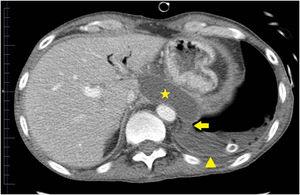 CT with intravenous contrast (in axial plane) displaying an oval-shaped fluid collection with well-defined walls (star), in a retrogastric site that communicates (solid arrow) with a left pleural effusion (arrow head).
