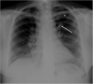 The chest radiography reveals left hilar tubular opacite (arrow) and hyperaeration (asterisk) in the upper zone of the left lung.