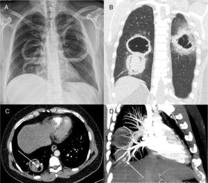 Posteroanterior chest radiograph (A) showing three large cavitary lesions, two on the right lung and one on the left, with air-fluid levels. Coronal computed tomography image (B) obtained with the lung window setting demonstrating the thick-walled cavitary lesions, with solid content in one lesion on the right. Axial contrast-enhanced image (C) obtained with the mediastinal window setting depicting the solid content in the lower cavity, with a highly enhancing nodule inside (arrow), compatible with an aneurysm. Computed tomography–pulmonary angiography image (D) demonstrating that the pseudoaneurysm is related to a peripheral pulmonary artery (arrow).