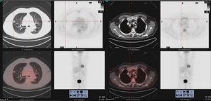 18F-FDG PET/CT scan images showing (on the left) a solid spiculated hypermetabolic nodule (SUVmax7.5), in punctiform contact with the pleura and the fissure, measuring about 14mm, located in the anterior segment of the right upper lobe. Hypermetabolic bone lesion (on the right) with lytic component at the distal end of the right clavicle (SUVmax 8.4).