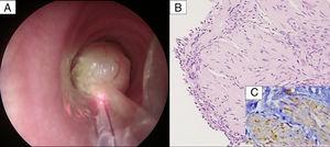 (A) Image of the endotracheal tumor via the rigid bronchoscope, with the Nd:YAG laser fiber and aspiration probe. (B) Proliferation of spindle cells, cigar-shaped nuclei, and elongated cytoplasms, below the bronchial epithelium, H–E ×20. (C) S100 positivity for in these cells, ×40.