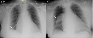 (a) Chest X-ray showing nasogastric tube (arrow) in the right hemithorax; (b) complete right pneumothorax (arrow).