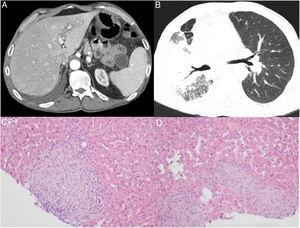 (A) Abdominal CT: heterogeneous and nodular hepato-splenomegaly. (B) Chest CT-transplanted lung: normal appearance. Right lung: signs of pseudotumoral silicosis with massive fibrosis and confluence of silicotic aggregates; both CT scans show a small right-sided pleural effusion that was already present before the transplantation and remains stable since then. This diagnosis is based on the history of substantial exposure to silica dust during 30 years, compatible radiological features, consistent BAL findings and exclusion of other competing diagnoses. (C) and (D) Liver biopsy: epithelioid granulomas.