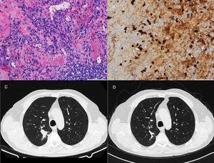 Histological and radiological results from case 2: (A) hematoxylin and eosin stain, (B) immunohistochemistry for IgG4-positive plasma cells, (C) CT images at the time of diagnosis, and (D) CT images after 3 months of therapy.