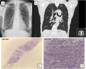 (A) Chest radiograph shows bilateral apical subpleural thickening; (B) coronal CT imaging shows subpleural thickening and reticular opacities with traction bronchiectasis in the parenchyma at the upper lobes, more predominant in the right side; (C) 1 • low magnification showing fibroelastotic scarring; 2 • at high magnification the typical mixture of fragmented elastic fibres and collagen.