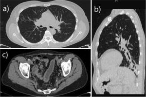 (a) Axial CT slice in pulmonary window showing micronodular opacities with tree-in-bud distribution in the lateral segment of the middle lobe, consistent with infectious airway involvement. (b) Sagittal CT reconstruction in pulmonary window showing peripheral opacity of infectious appearance in the left lower lung associated with bronchiectasis. (c) Axial contrast-enhanced CT scan of the pelvis in soft tissue window, showing sigmoid colon wall thickening and submucosal edema of chronic appearance, related with the patient’s inflammatory bowel manifestation.