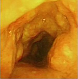 Nodular involvement of tracheal wall in endobronchial image.