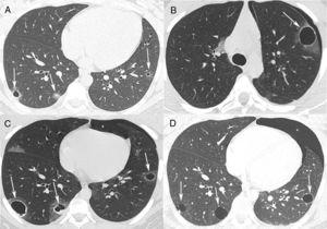 (A) Axial chest CT with pulmonary window settings shows bilateral small pulmonary nodules, two of which are cavitated (arrows). (B, C) CT performed 4 months later demonstrates a left spontaneous pneumothorax (asterisk) and growth of the nodules, which now present with relatively thick walls and ground-glass halos (arrows). (D) CT performed 1 year after A shows a new left pneumothorax (asterisk) and evolution of the cavitated nodules into thin-walled cystic lesions (arrows).