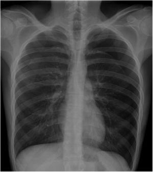 Chest X-ray in maximum inspiration, showing complete left pneumothorax and partial right pneumothorax.