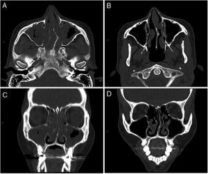 Computed tomography of the sinuses, axial (A and B) and coronal (C and D) slices. A and C: before treatment with mepolizumab: left septal deviation. Marked mucosal thickening of both maxillary sinuses, ethmoidal air cells, and both nostrils. Exudate in both maxillary sinuses. B and D: after 4 months of treatment with mepolizumab: minimum mucosal thickening in the maxillary sinuses. Mucosal thickening and polypoid formations of both nostrils.