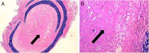 BO typical lesion observed in control group (CG) (25×, H–E). The tissue located in the lumen of the allograft is mainly formed by scar tissue (collagen and fibroblastic cells) (black arrows). (A) Overview of a section of the tracheal segment. (B) Detail of the scar tissue (collagen and fibroblastic cells).