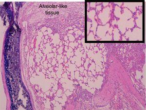 Alveolar-like tissue described in the lumen of the tracheal segment in BMSC groups (25×, H–E). As it can be seen in the amplification in the right corner, the tissue is mimicking the alveolar structure.