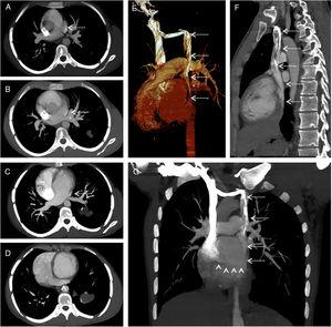 Contrast-enhanced axial consecutive CT scans (A–D) reveal a left superior vena cava (dashed arrows) drained into the coronary sinus (arrow head). There is no association with the left pulmonary veins of the left superior vena cava. 3D volume rendered (E) and sagittal (F) and coronal (G) MIP CT images demonstrate clearly the left superior vena cava (dashed arrows) drained into the coronary sinus (arrow heads).