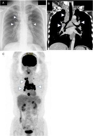 (A) Chest radiograph showing bilateral hilar lymphadenopathy. (B) Chest computed tomography scan showing the bilateral hilar and mediastinal lymphadenopathy. (C) [18F]-fluorodeoxyglucose positron emission tomography scan showing the so-called “lambda (λ) sign”, indicating a high uptake in the bilateral hilar and mediastinal lymphadenopathy with a prominent right paratracheal region.