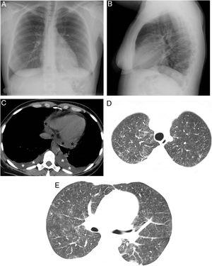 (A and B) Posteroanterior and lateral projections in which no parenchymal consolidations can be seen. A probable small left subpulmonic pleural effusion is observed, on noting an increased distance between the stomach and left lung base. (C) Axial chest CT scan (mediastinal window) showing new-onset bilateral pleural effusions (white asterisks) and pericardial effusion (black asterisks). (D and E) Axial chest CT scans (lung parenchyma window) in which new-onset bilateral ground-glass opacities are observed.