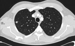 Chest CT showing a solitary nodule 1 cm in diameter in the right upper lobe.