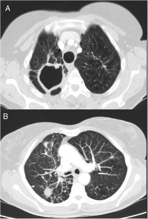 Chest CT. (A) Image of sequelae from previous tuberculous process, with signs of volume loss in both upper lobes and parenchymal scars with large cavitation in right apex. (B) View of multiple bilateral and diffuse nodules, some cavitated, and micronodular tree-in-bud pattern in right lower lobe and middle lobe, associated with the current infectious process.