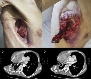 (A) Tumor protruding through the permanent open thoracostomy space. (B) Extensive growth of the tumor occupying the entire space days later. (C and D) Axial CT slices showing thoracostomy and tumor.